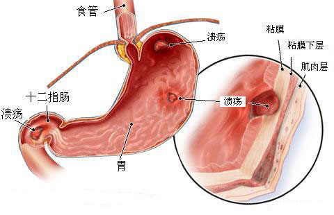 中西医结合治疗消化性溃疡，标本兼治治疗效果好