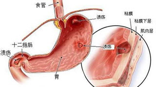 浅表性胃炎严重吗