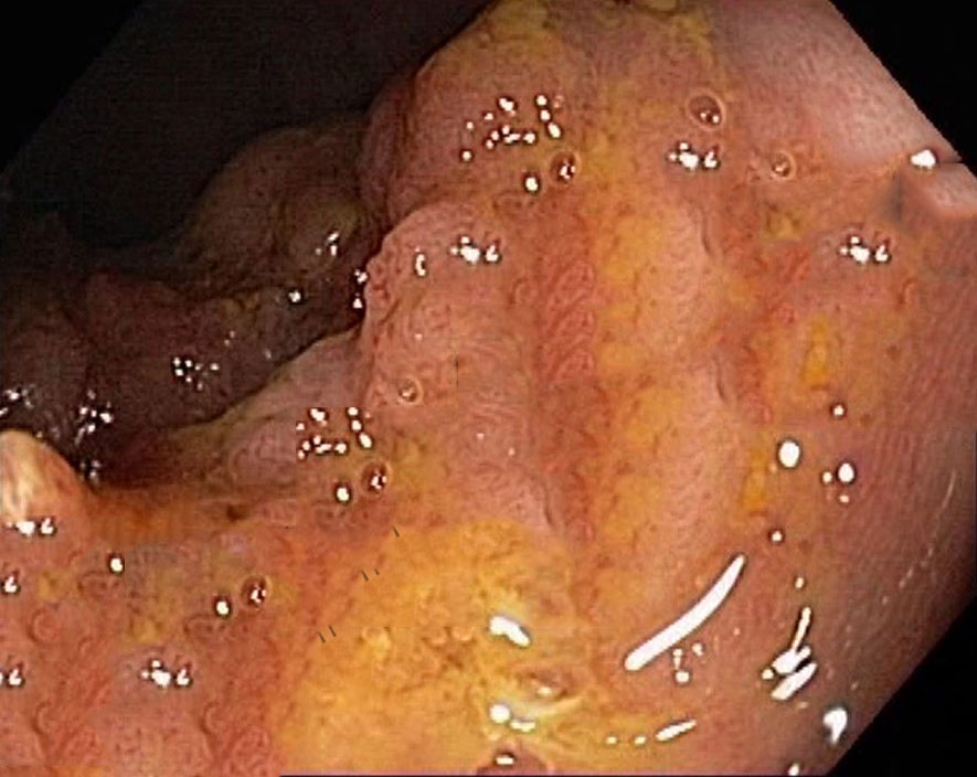 直肠绒毛状腺瘤