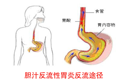 诱发反流性胃炎的原因有哪些