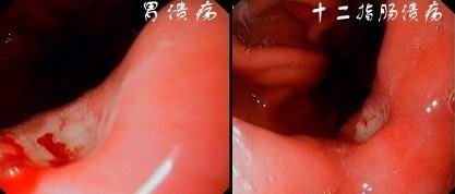 胃镜下胃溃疡与十二指肠溃疡的区别