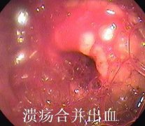 治疗十二指肠溃疡