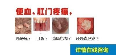 肛门疼痛便血?在线咨询丰益医生