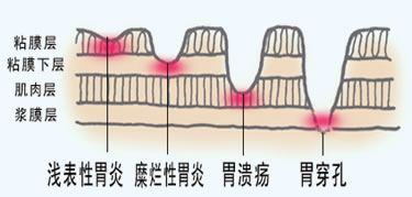 糜烂性胃炎